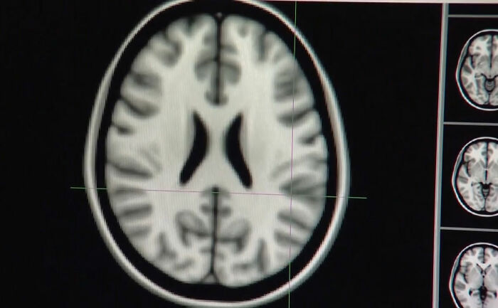 Internautas divididos após estudo revelar que hábito praticado por 18 milhões de americanos pode causar danos cerebrais permanentes