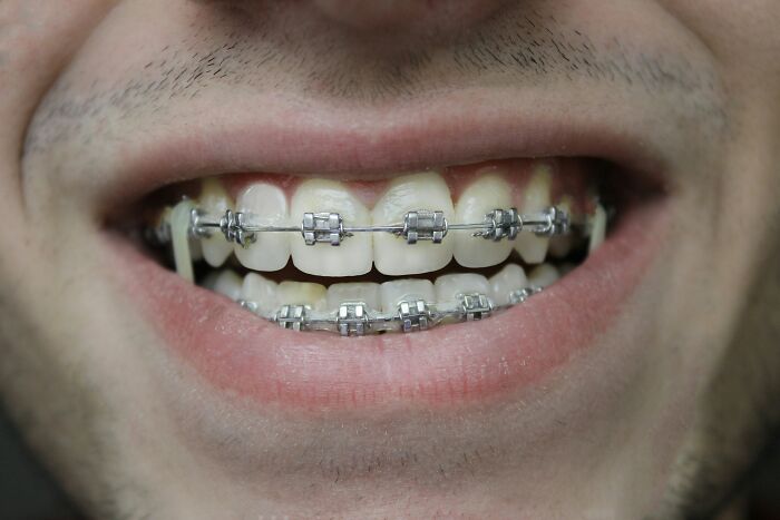 A close-up of a person smiling, showing teeth with braces. This image could relate to family secrets or personal revelations.