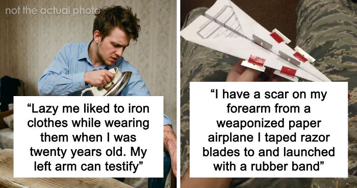 “Just To Prove I Was Tough”: Everyone Makes Mistakes, But These 47 People’s Stupid Injury Stories Hurt To Read