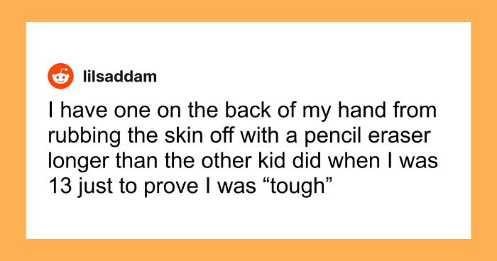 “Just To Prove I Was Tough”: Everyone Makes Mistakes, But These 47 People’s Stupid Injury Stories Hurt To Read