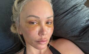 15 Times Celebrities And Influencers Shared Their Plastic Surgery Results Openly