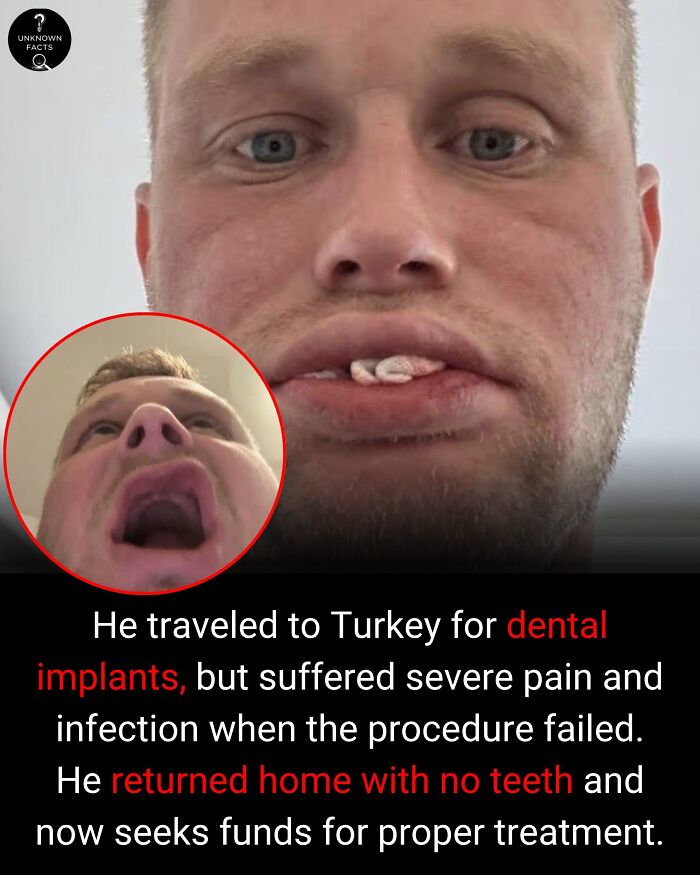 A man with failed dental implants, suffering pain, and seeking funds. An interesting fact about medical tourism gone wrong.