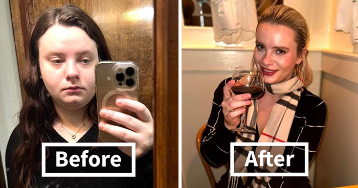 Woman Shows Her Crazy Transformation, People Can’t Believe It: “Lip Fillers, Botox, Weight Loss”