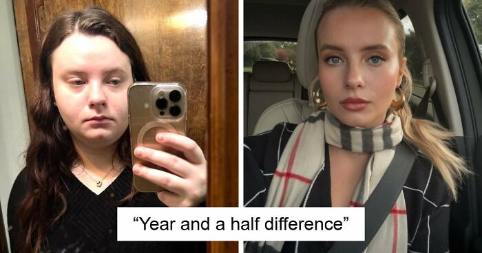 Woman Shows Her Crazy Transformation, People Can’t Believe It: “Lip Fillers, Botox, Weight Loss”