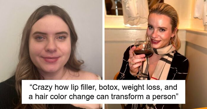 Woman Shows Her Crazy Transformation, People Can’t Believe It: “Lip Fillers, Botox, Weight Loss”