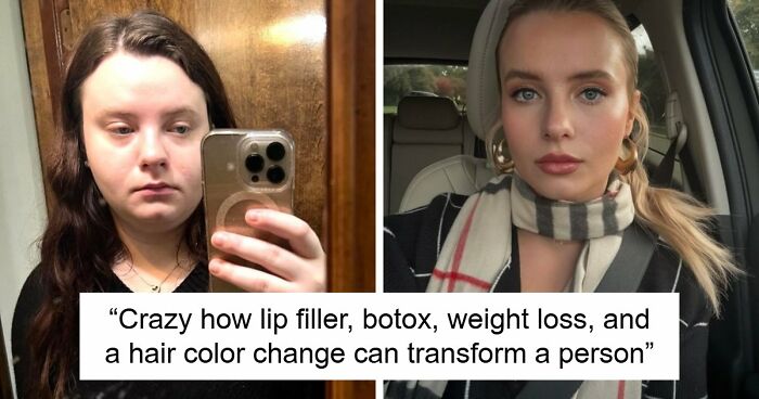 Woman Shows Her Crazy Transformation, People Can’t Believe It: “Lip Fillers, Botox, Weight Loss”