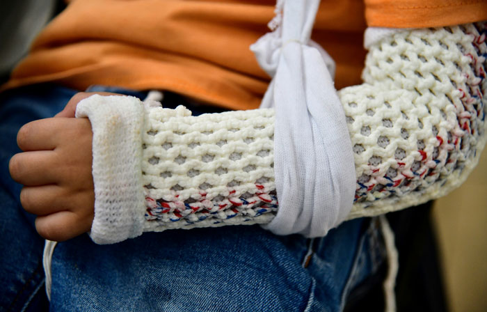 Person with arm in medical cast and sling due to injury