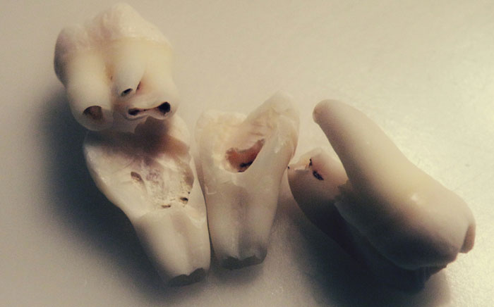 Three extracted human teeth with dark spots, possibly cavities or decay, on a white surface. Weirdest packages.