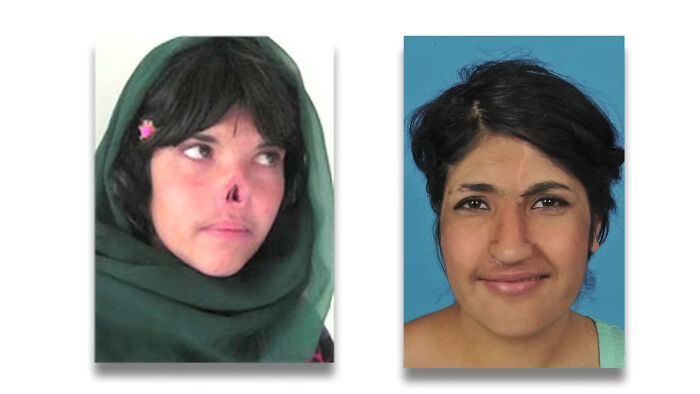 Image of a woman with nose injury and text about a horrific punishment from in-laws