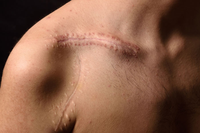 Close-up of shoulder with prominent surgical scar and healing skin