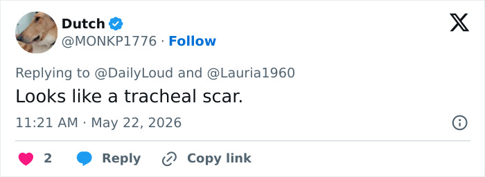 Tweet suggests retired Navy Vice Admiral has a tracheal scar in viral Fox News appearance Tweet suggests retired Navy Vice Admiral has a tracheal scar in viral Fox News appearance