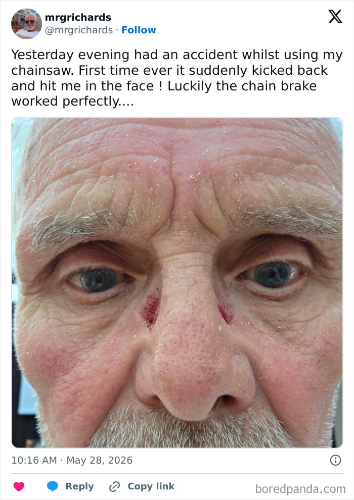Closeup of face with small facial injuries from a chainsaw accident