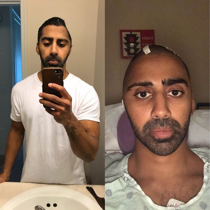 Man before and after medical procedure showing healing progress