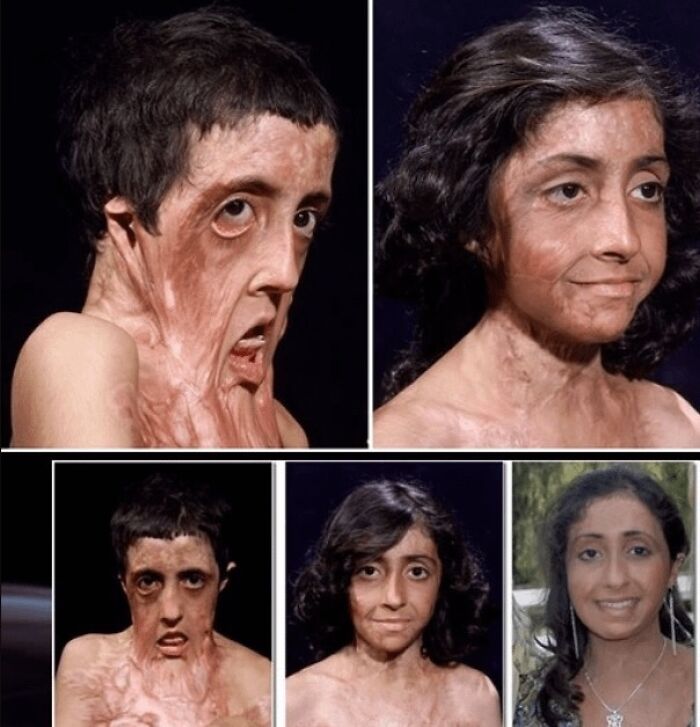 Series of photos showing woman’s recovery and healing from severe burns