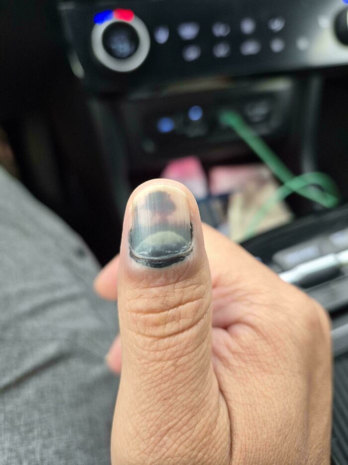 Thumb with dark discoloration looks like a tiny person face in pareidolia
