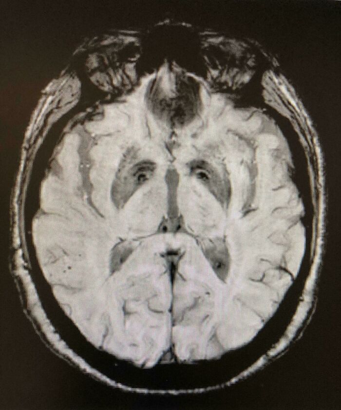 Brain MRI scan showing pareidolia with a face-like pattern in brain structure