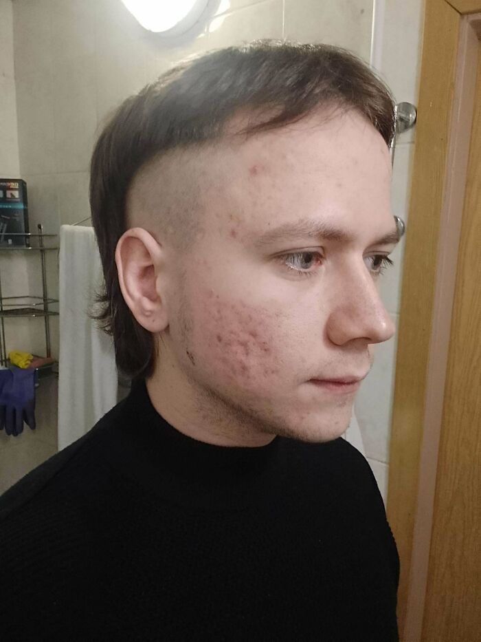 Young man with a bad haircut that includes a mullet and shaved sides, showing acne on his face.