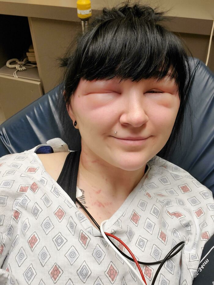 A young woman with extremely swollen, red eyes and red marks on her neck, wearing a hospital gown, a beauty disaster.
