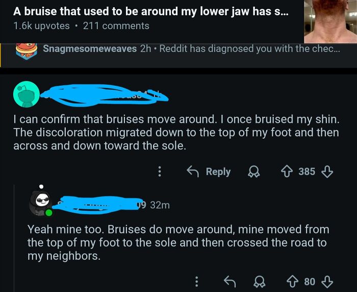 Funny Reddit comments about bruises moving around the body