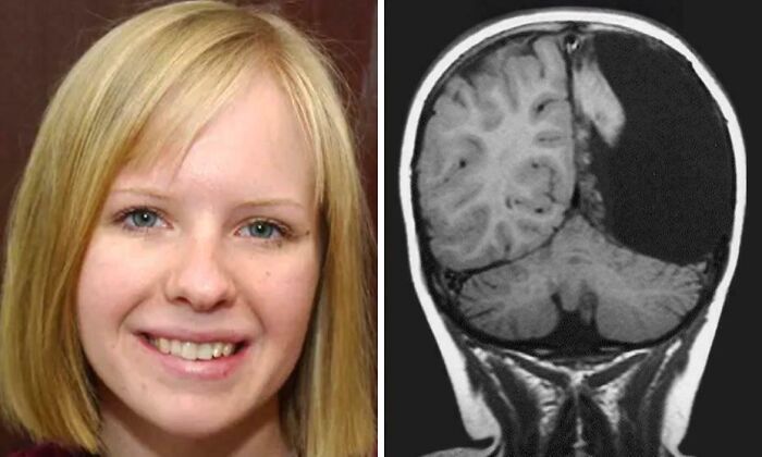 Young woman and brain MRI showing large brain cyst curiosity