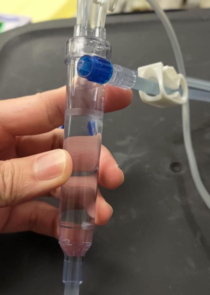 Closeup of a hand holding a medical IV drip with fluid inside