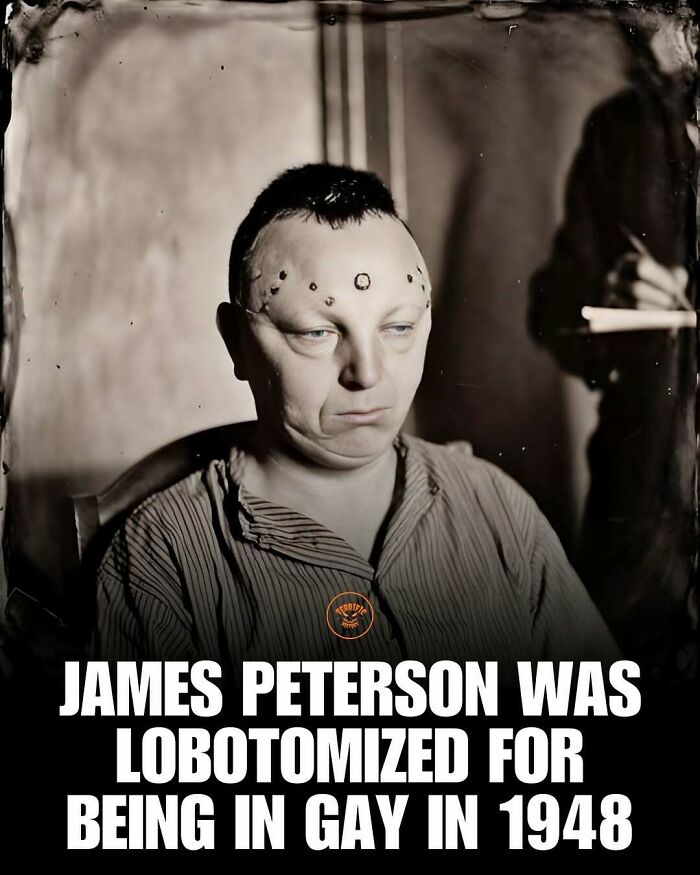 Black and white photo of lobotomized man with unusual marks on head, historical lobotomy fact