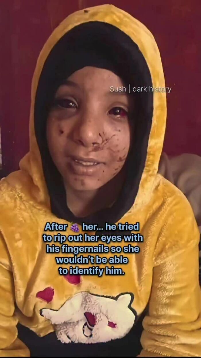 Girl in yellow hoodie with facial injuries and text on eye mutilation in creepy historical facts