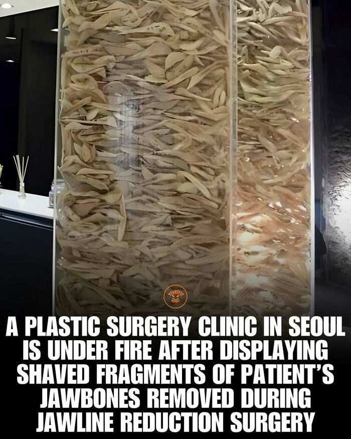 Plastic surgery clinic in Seoul under fire for displaying shaved jawbone fragments