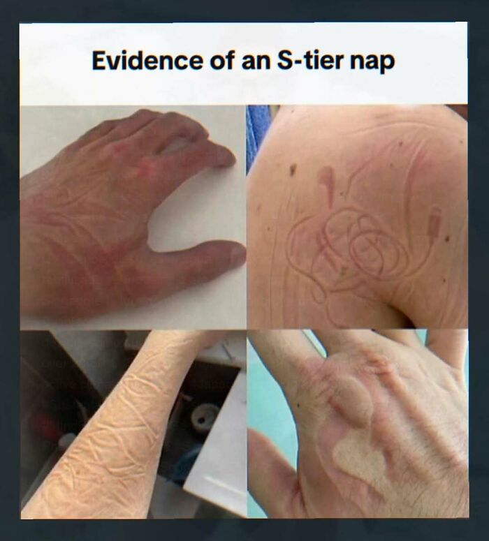 Red skin impressions on hand and arm from nap