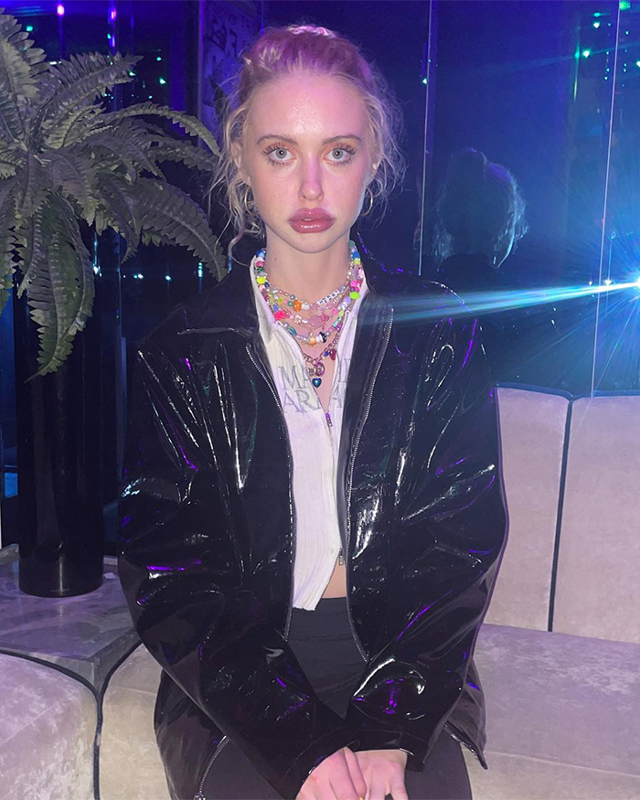 Woman sitting indoors in shiny black jacket with large lips after lip filler procedures