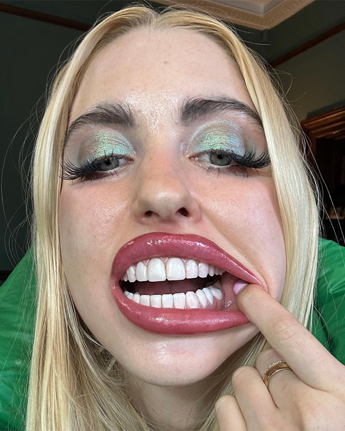 Chloe Cherry showing extreme lip filler results with makeup