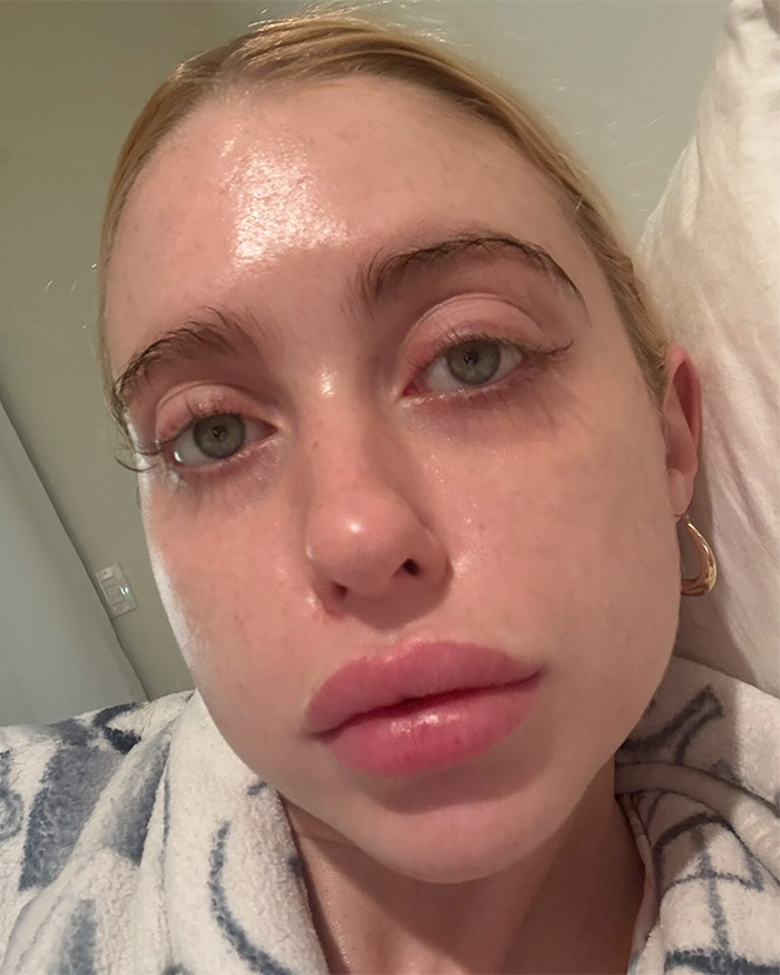 Chloe Cherry selfie highlighting swollen lips after lip filler procedures