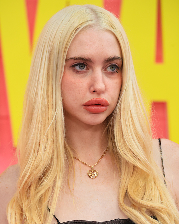 Close up of Chloe Cherry showing effects of repeated lip filler procedures