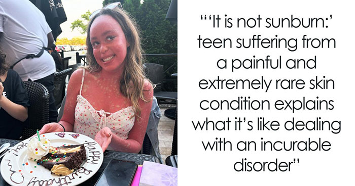 Teen With An Extremely Rare Skin Condition Talks About Her Struggles Online, Ends Up Going Viral