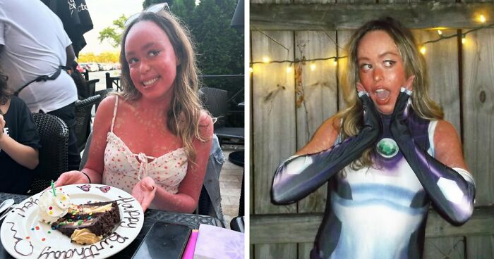 Teen With An Extremely Rare Skin Condition Talks About Her Struggles Online, Ends Up Going Viral