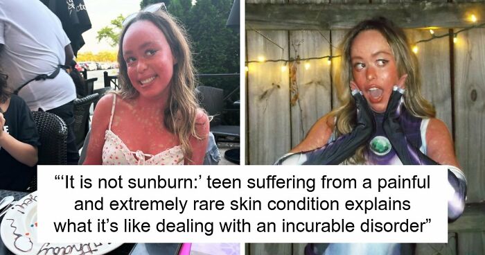 Teen With An Extremely Rare Skin Condition Talks About Her Struggles Online, Ends Up Going Viral