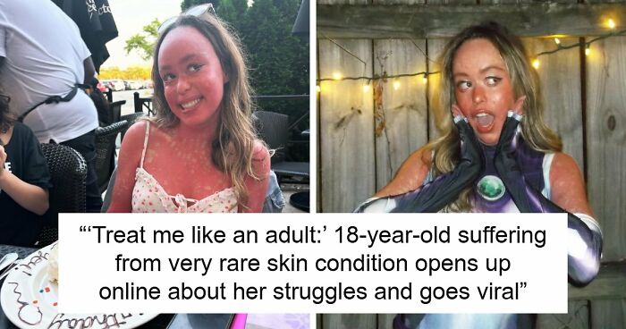Teen With An Extremely Rare Skin Condition Talks About Her Struggles Online, Ends Up Going Viral
