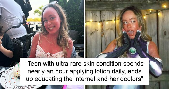 Teen With An Extremely Rare Skin Condition Talks About Her Struggles Online, Ends Up Going Viral