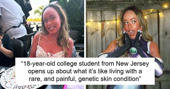 Teen With An Extremely Rare Skin Condition Talks About Her Struggles Online, Ends Up Going Viral
