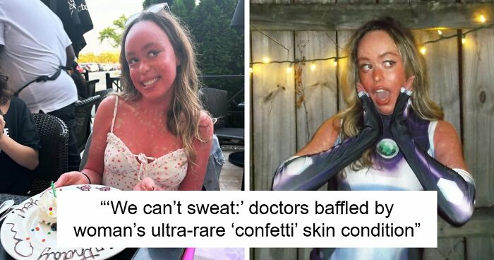 Teen With An Extremely Rare Skin Condition Talks About Her Struggles Online, Ends Up Going Viral