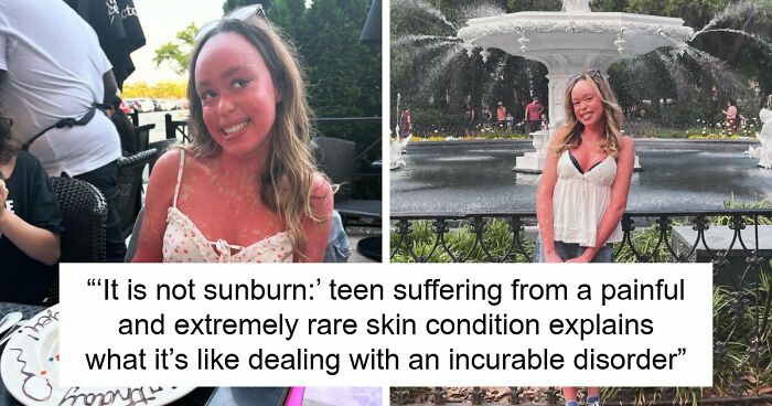 Teen With An Extremely Rare Skin Condition Talks About Her Struggles Online, Ends Up Going Viral