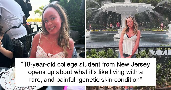 Teen With An Extremely Rare Skin Condition Talks About Her Struggles Online, Ends Up Going Viral