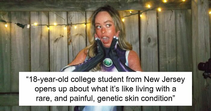 Teen With An Extremely Rare Skin Condition Talks About Her Struggles Online, Ends Up Going Viral