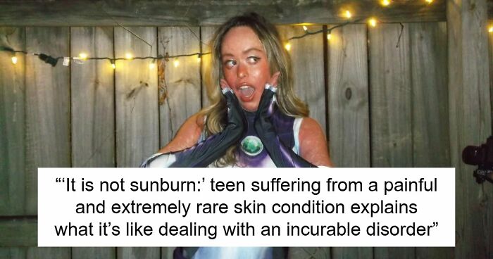 Teen With An Extremely Rare Skin Condition Talks About Her Struggles Online, Ends Up Going Viral