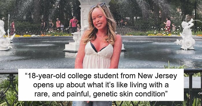 Teen With An Extremely Rare Skin Condition Talks About Her Struggles Online, Ends Up Going Viral