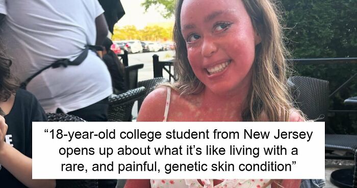 Teen With An Extremely Rare Skin Condition Talks About Her Struggles Online, Ends Up Going Viral