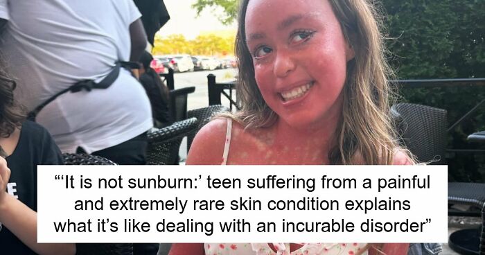Teen With An Extremely Rare Skin Condition Talks About Her Struggles Online, Ends Up Going Viral
