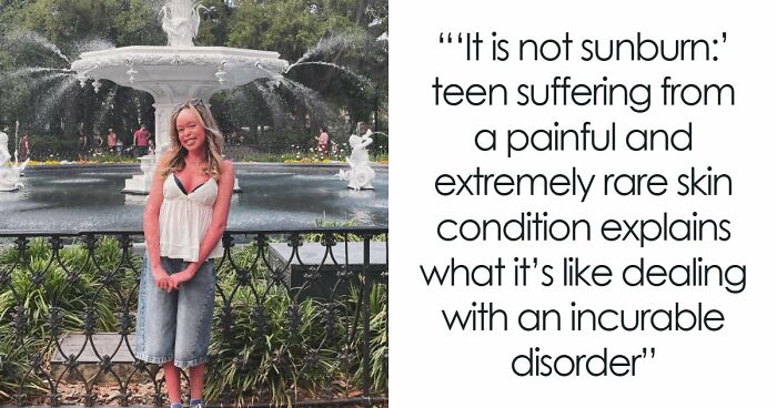 Teen With An Extremely Rare Skin Condition Talks About Her Struggles Online, Ends Up Going Viral