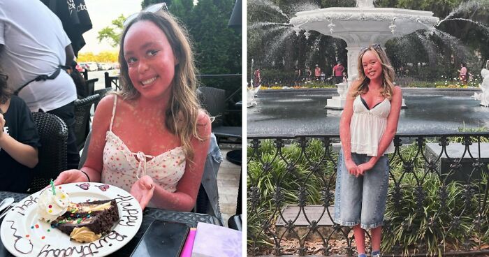Teen With An Extremely Rare Skin Condition Talks About Her Struggles Online, Ends Up Going Viral