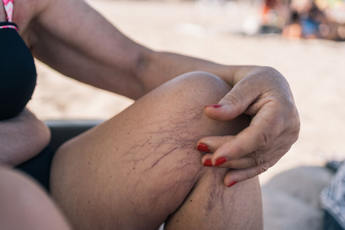 Woman on a beach, touching her leg with prominent spider veins, a health warning sign. Routine Cancer Screening reminder.